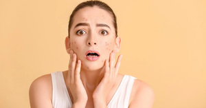 Acne Management Throughout Your Cycle